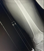 ATTELLE STS GENERATION 2 - TRACTION FEMUR SLISHMAN TRACTION SPLINT